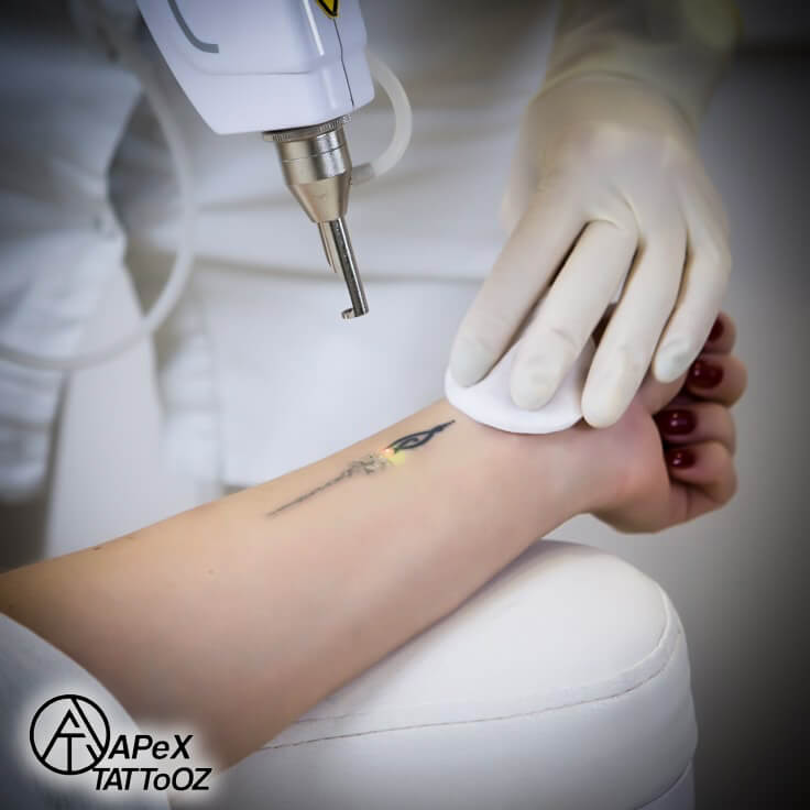 Laser Tattoo Removal Session