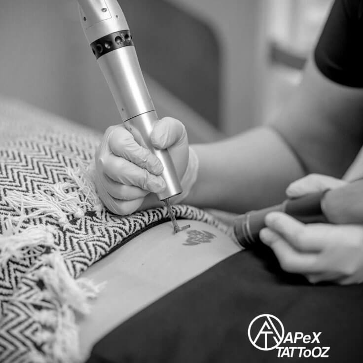 Tattoo Removal