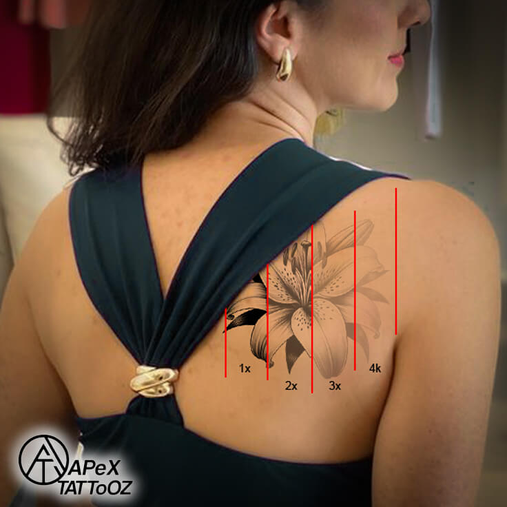 Tattoo Removal Before After